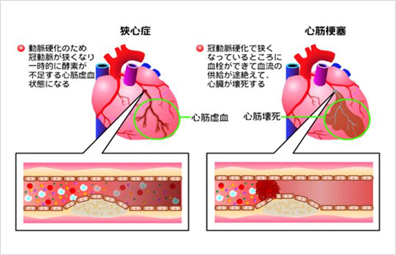 狭心症　動脈硬化のため冠動脈が狭くなり、一時的に酸素が不足する心筋虚血状態になる　心筋梗塞　冠動脈硬化で狭くなっているところに血栓ができて血流の供給が途絶えて心臓が壊死する
